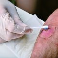 How to Identify and Treat Wound Infection Symptoms Using Advanced Care Supplies