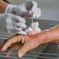 Who is Qualified to Perform Wound Debridement? A Guide from an Expert's Perspective