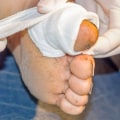 Managing Arterial Insufficiency Leg Ulcers: Must-Have Wound Care Supplies