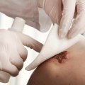 Choosing The Right Wound Care Supplies For A Macerated Skin Wound