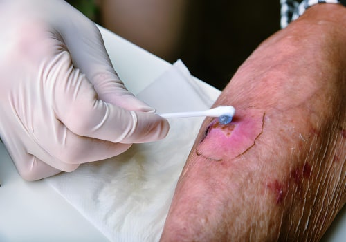 How to Identify and Treat Wound Infection Symptoms Using Advanced Care Supplies