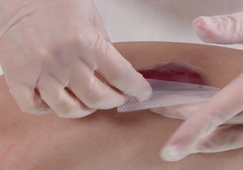 Slow Healing Wounds? Discover the Best Practices and Supplies for Effective Treatment