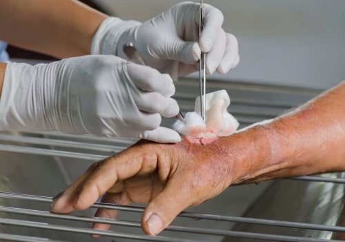 Who is Qualified to Perform Wound Debridement? A Guide from an Expert's Perspective