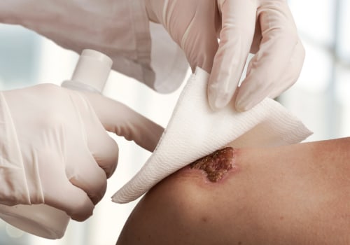 Choosing The Right Wound Care Supplies For A Macerated Skin Wound